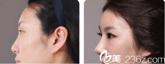 杭州愛琴海醫(yī)院隆鼻真人案例2