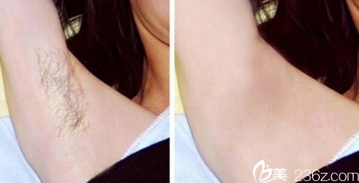 唐小姐腋下脫毛 張家口維多利亞