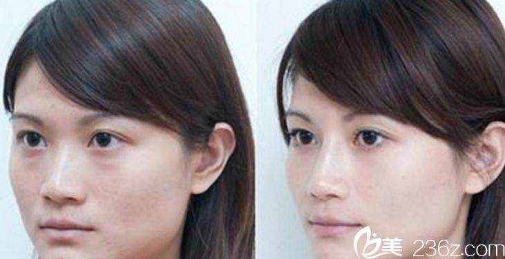 董小姐隆鼻案例 張家口維多利亞