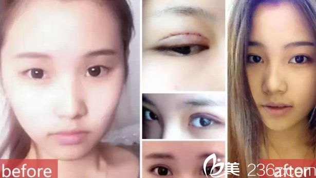 劉小姐雙眼皮案例 張家口維多利亞整形