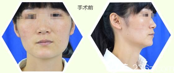自體脂肪填充加鼻綜合術(shù)前 自體脂肪填充加鼻綜合術(shù)前