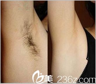 駐馬店美蘭德脫腋毛案例 駐馬店美蘭德脫腋毛案例