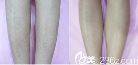 駐馬店美蘭德脫腿毛案例 駐馬店美蘭德脫腿毛案例