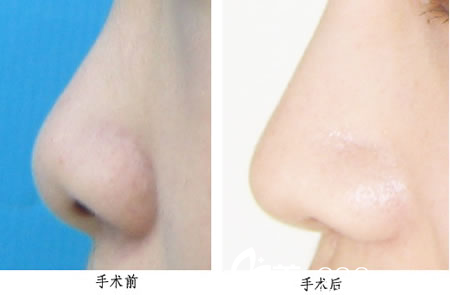 鼻部整形手術(shù)前后對比圖
