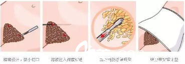 S形體雕塑吸脂術(shù) S形體雕塑吸脂術(shù)