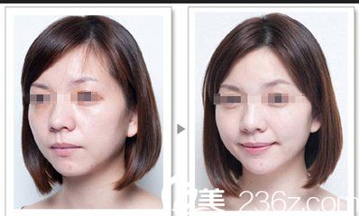 玻尿酸豐蘋果肌前后對比圖