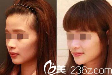 玻尿酸隆下巴---頜面整形前后對比圖