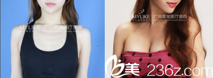 廣州美萊<!--<i data=20240703-sp></i>-->隆胸<span style=