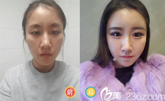 元彰焄院長的面部整形案例 元彰焄院長的面部整形案例