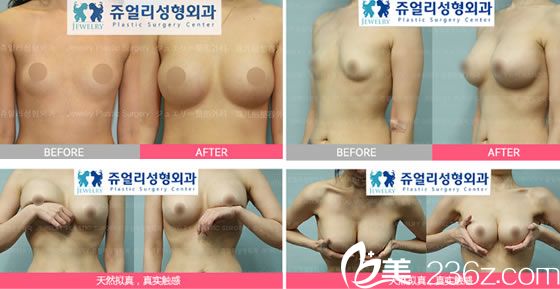 林炯佑院長的隆胸案例圖