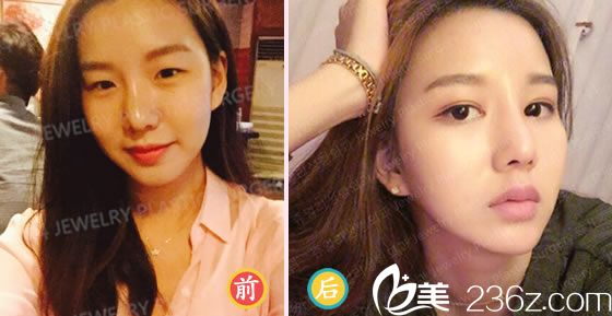 柳然植院長的雙眼皮案例