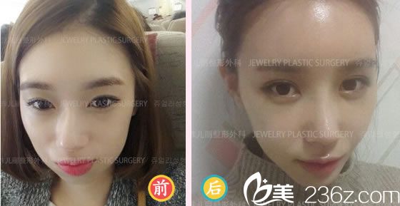 柳然植院長鼻修復(fù)案例