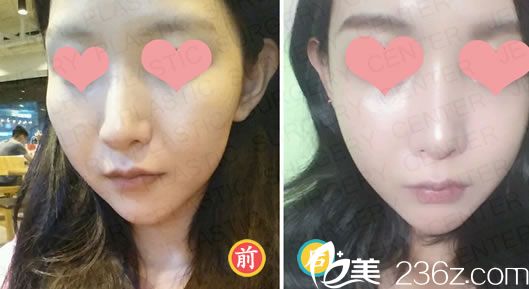 申奇澈院長的輪廓整形案例 申奇澈院長的輪廓整形案例