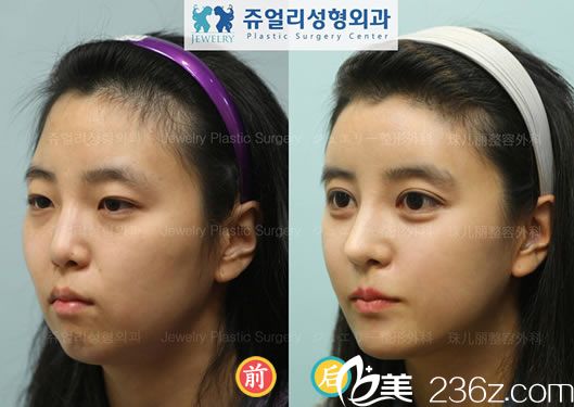 尹容逸院長的鼻梁整形案例 尹容逸院長的鼻梁整形案例