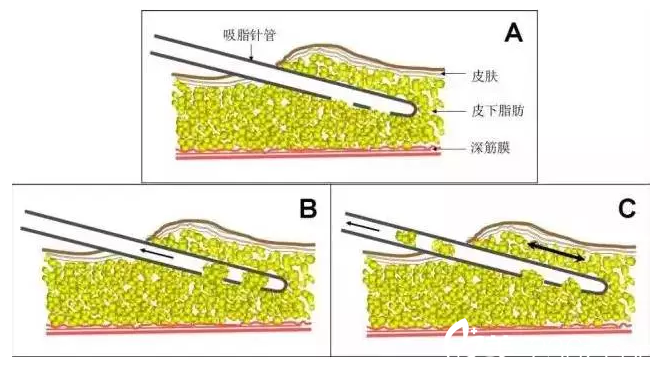 吸脂術(shù)吸走脂肪細胞 吸脂術(shù)吸走脂肪細胞