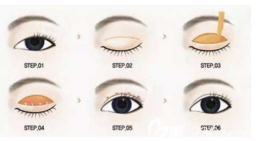 雙眼皮的手術方法