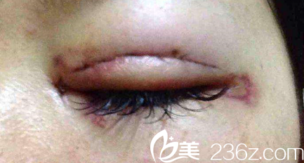 雙眼皮手術的腫脹階段