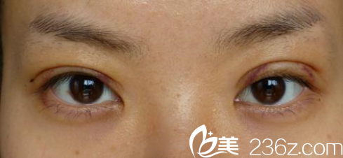 雙眼皮術后的快消階段