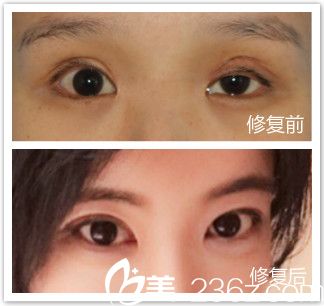 韓國清潭雙眼皮修復案例