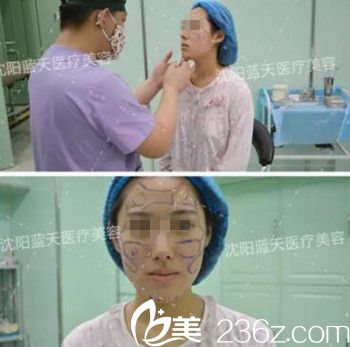 在沈陽藍天做面部脂肪填充手術(shù)設(shè)計.jpg 在沈陽藍天做面部脂肪填充手術(shù)設(shè)計.jpg