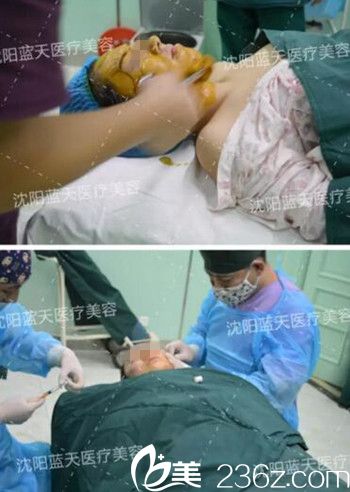 在沈陽藍天做面部脂肪填充手術(shù)中.jpg 在沈陽藍天做面部脂肪填充手術(shù)中.jpg