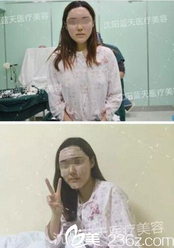 在沈陽藍天做面部脂肪填充手術(shù)當(dāng)天.jpg 在沈陽藍天做面部脂肪填充手術(shù)當(dāng)天.jpg