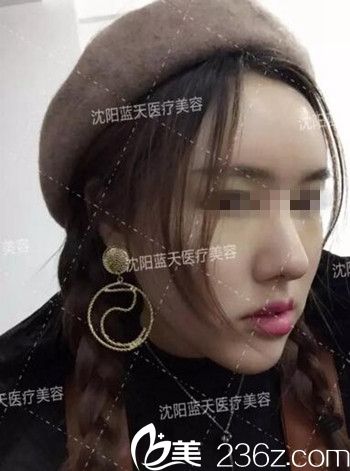 在沈陽藍天做面部脂肪填充術(shù)后半個月.jpg 在沈陽藍天做面部脂肪填充術(shù)后半個月.jpg