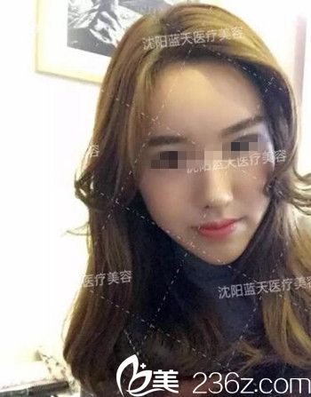 在沈陽藍天做面部脂肪填充術(shù)后45天.jpg 在沈陽藍天做面部脂肪填充術(shù)后45天.jpg