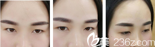 術前單眼皮的我 術前單眼皮的我