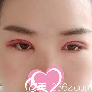 做手術2天后眼睛腫脹厲害 做手術2天后眼睛腫脹厲害