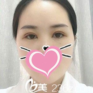 雙眼皮術后5天恢復狀況 雙眼皮術后5天恢復狀況