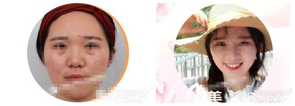 激光祛斑祛痘手術(shù)前后對比圖