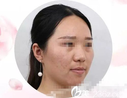 激光美膚手術(shù)三天后