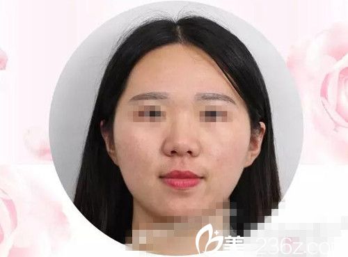 激光美膚手術(shù)7天后