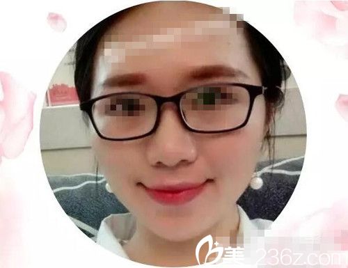 激光手術(shù)30天后