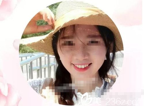 激光手術(shù)一年后