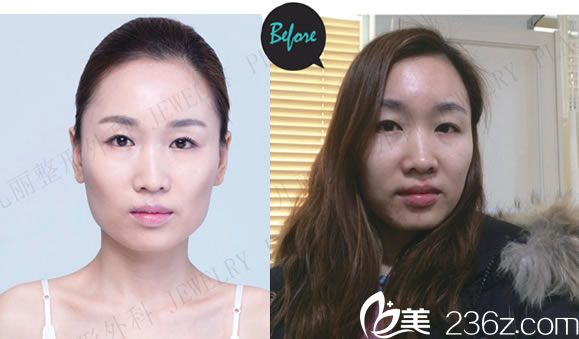 熙熙做輪廓手術(shù)前的照片