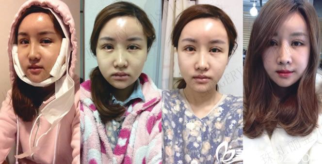 熙熙做完手術(shù)前四天的恢復(fù)圖片