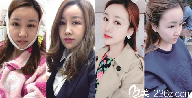 做完輪廓手術(shù)1到6周的恢復(fù)圖