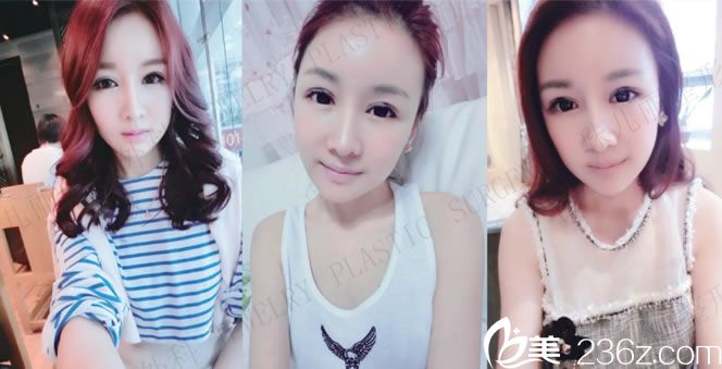 珠兒麗做完面部輪廓3月效果圖