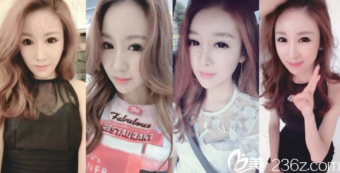 熙熙做輪廓手術(shù)變小臉的照片