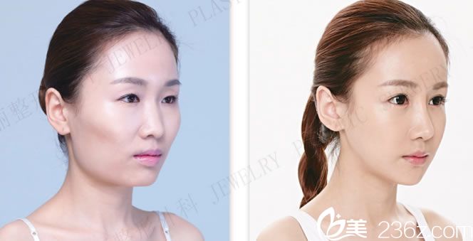 珠兒麗面部輪廓整形手術(shù)前后對比