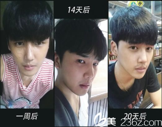 隆鼻手術(shù)前3周的效果圖 隆鼻手術(shù)前3周的效果圖