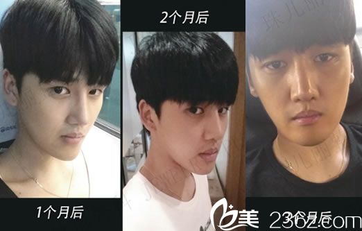 隆鼻手術(shù)3個(gè)月的效果怎么樣 隆鼻手術(shù)3個(gè)月的效果怎么樣