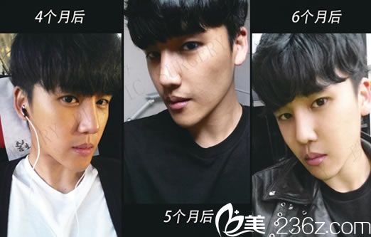 男士隆鼻手術(shù)第6個(gè)月恢復(fù)圖 男士隆鼻手術(shù)第6個(gè)月恢復(fù)圖