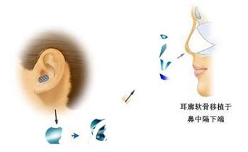 耳軟骨塑鼻尖