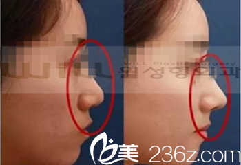 will醫(yī)院鼻綜合案例圖