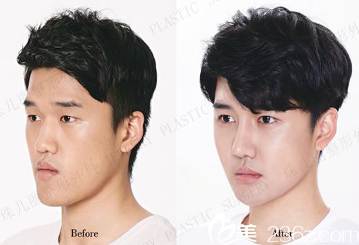 隆鼻手術(shù)前后效果對(duì)比照片 隆鼻手術(shù)前后效果對(duì)比照片