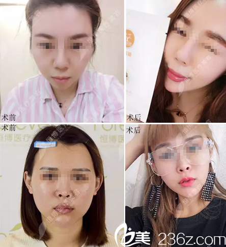 李烈面部脂肪填充案例對(duì)比照 李烈面部脂肪填充案例對(duì)比照