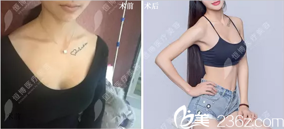 李烈自體脂肪豐胸前后對(duì)比 李烈自體脂肪豐胸前后對(duì)比